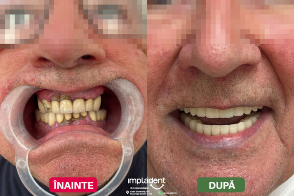 impladent - implanturi dentare