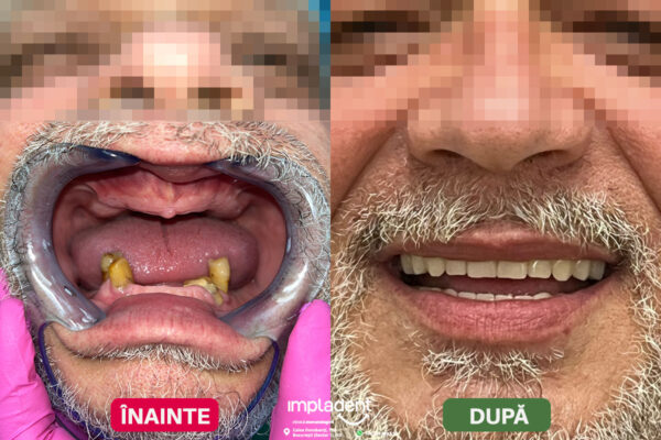 impladent - implanturi dentare