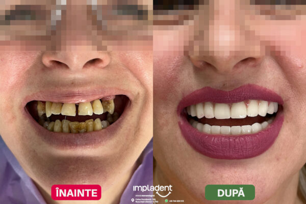 impladent - implanturi dentare