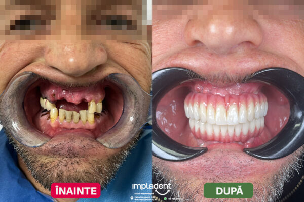 impladent - implanturi dentare