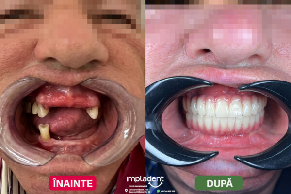 impladent - implanturi dentare