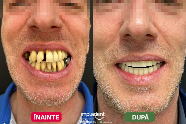 impladent - implanturi dentare