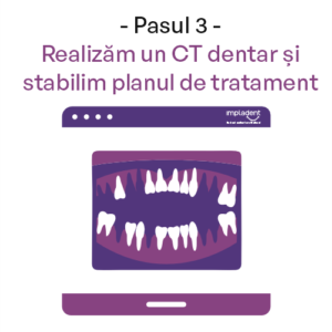 Dinti Ficsi All-on-4 All-on-6 - Clinica IMPLADENT Sector 1 Bucuresti Pasul 3