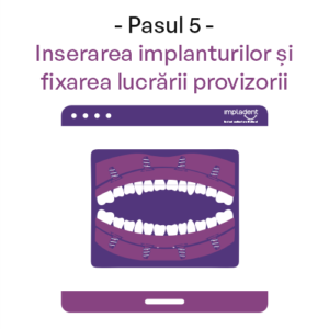 Dinti Ficsi All-on-4 All-on-6 - Clinica IMPLADENT Sector 1 Bucuresti Pasul 5