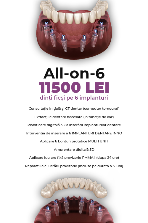 Dinti Ficsi All-on-6 Fast Fixed 11500 LEI - Clinica Stomatologică IMPLADENT Sector 1 București