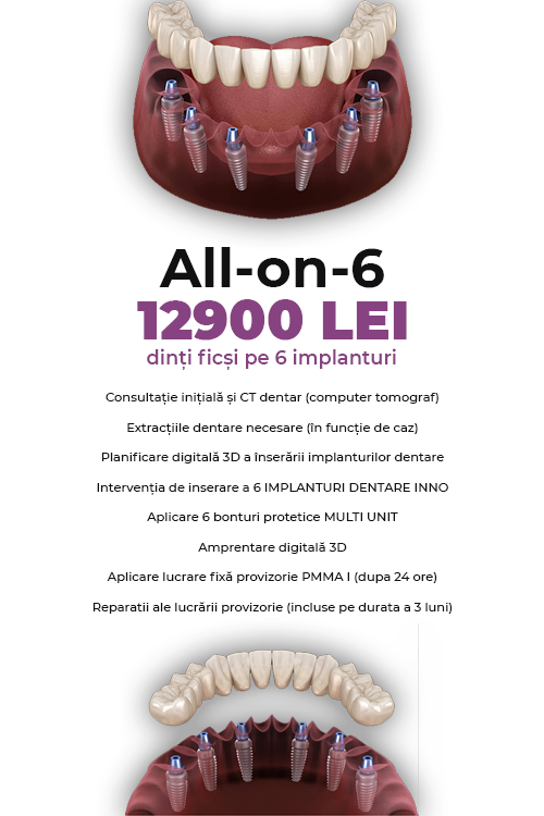 Dinti Ficsi All-on-6 Fast Fixed 12900 LEI - Clinica Stomatologică IMPLADENT Sector 1 București