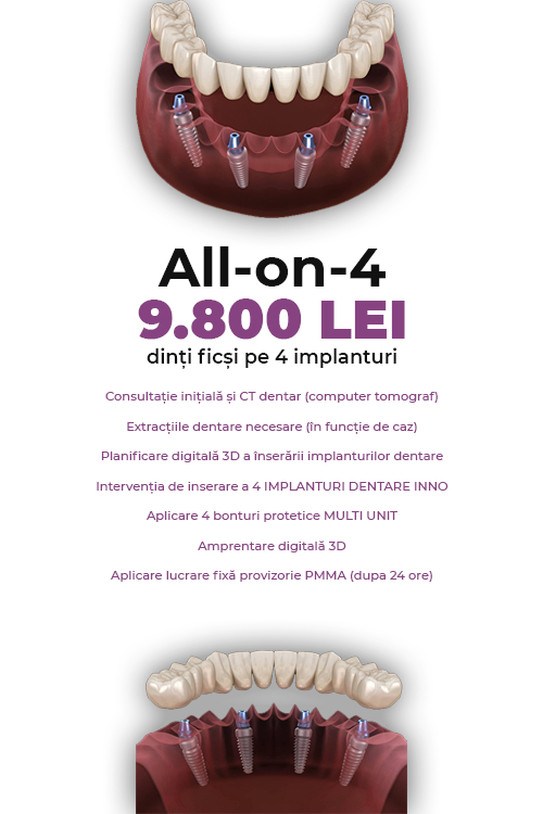 Dinti Ficsi All-on-4 Fast Fixed 9800 LEI - Clinica Stomatologică IMPLADENT Sector 1 București