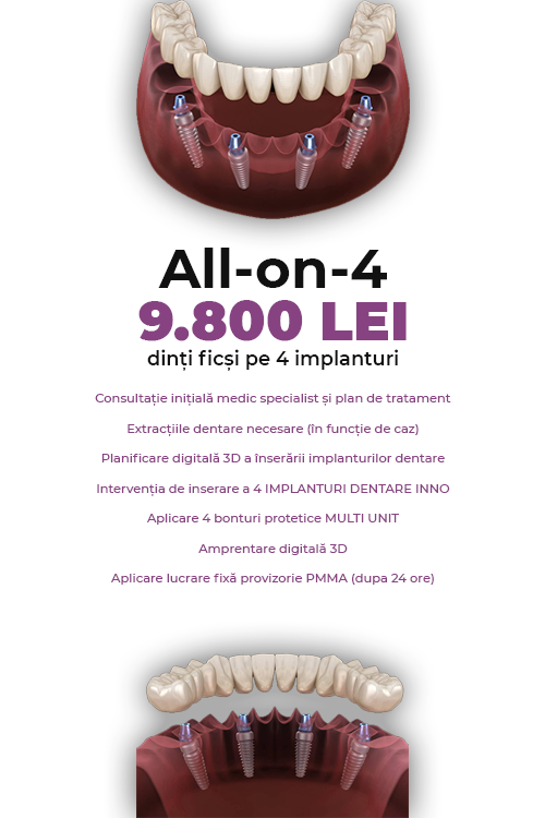 Dinti Ficsi All-on-4 Fast Fixed 9800 LEI - Clinica Stomatologică IMPLADENT Sector 1 București