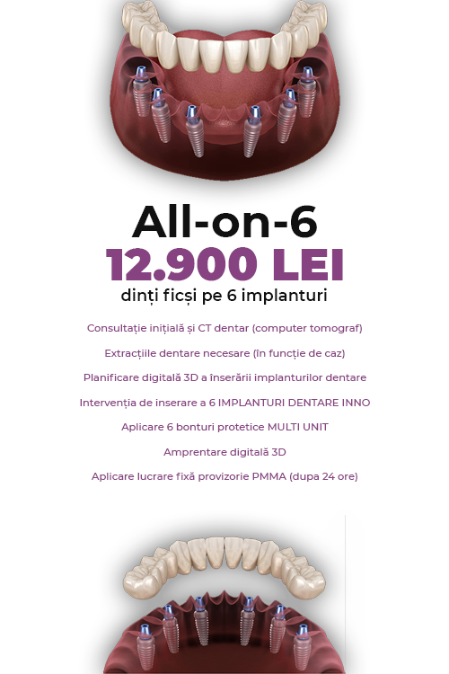 Dinti Ficsi All-on-6 Fast Fixed 12900 LEI - Clinica Stomatologică IMPLADENT Sector 1 București